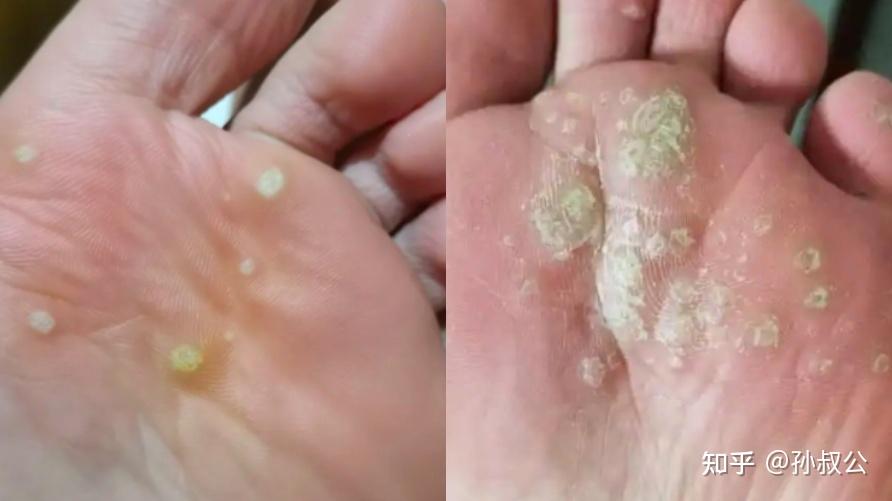脚底长疣 对身体有伤害吗? - 知乎