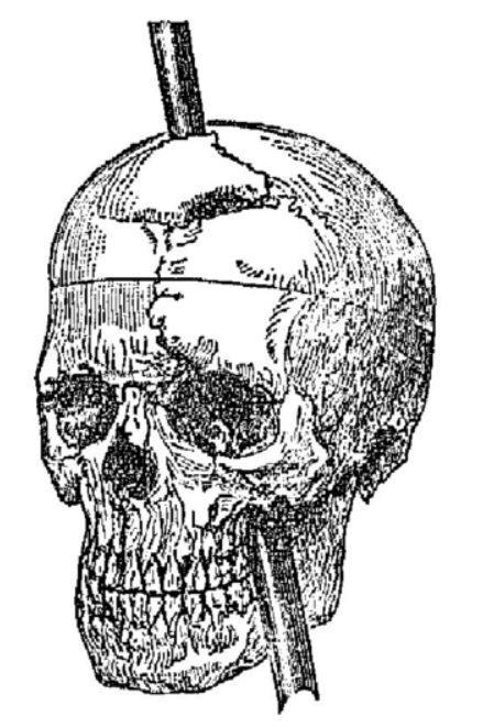 像动漫异度侵入中开洞那样脑袋上开个洞真的不会死吗