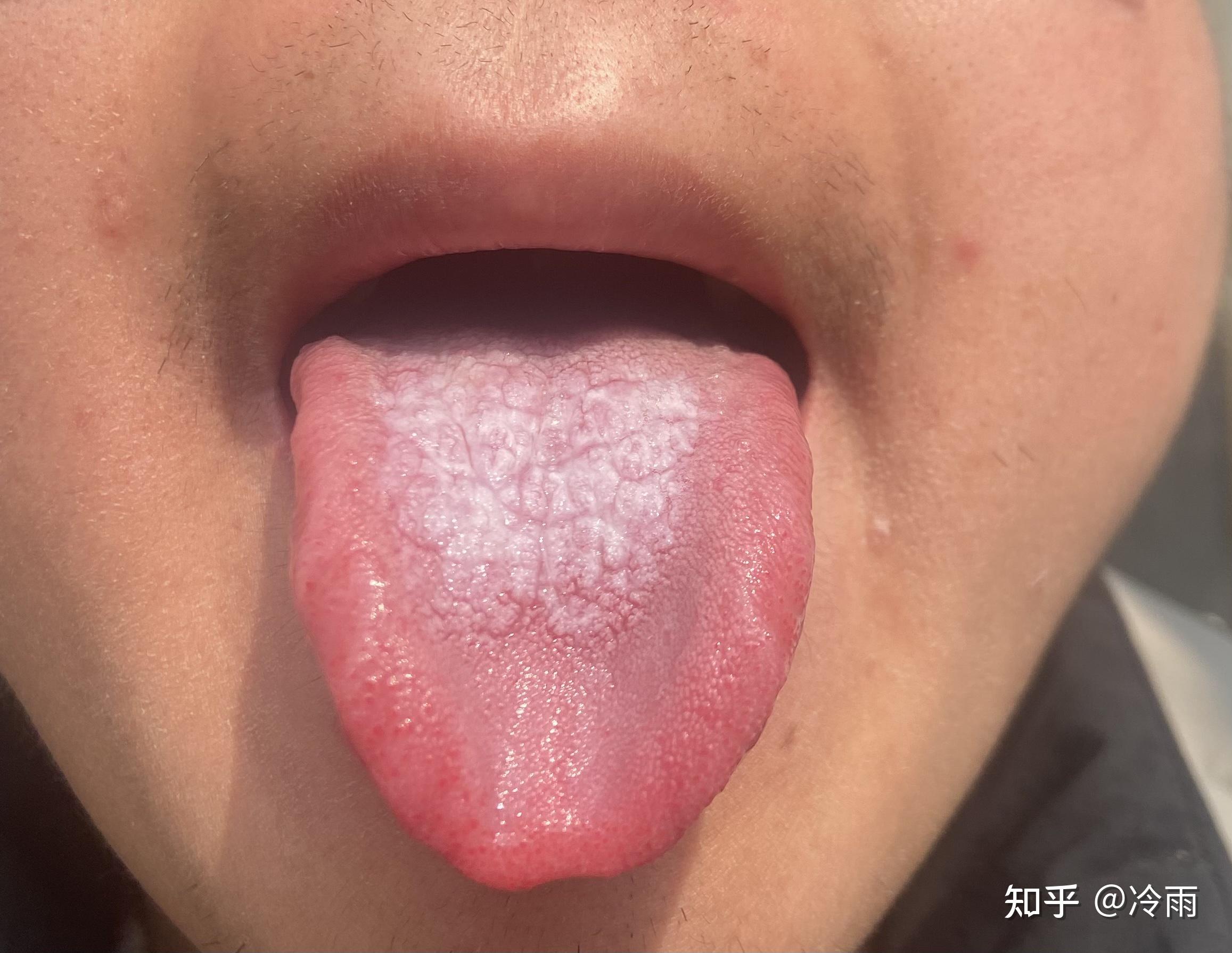 舌头中间有白斑这个是什么病会是舌癌吗
