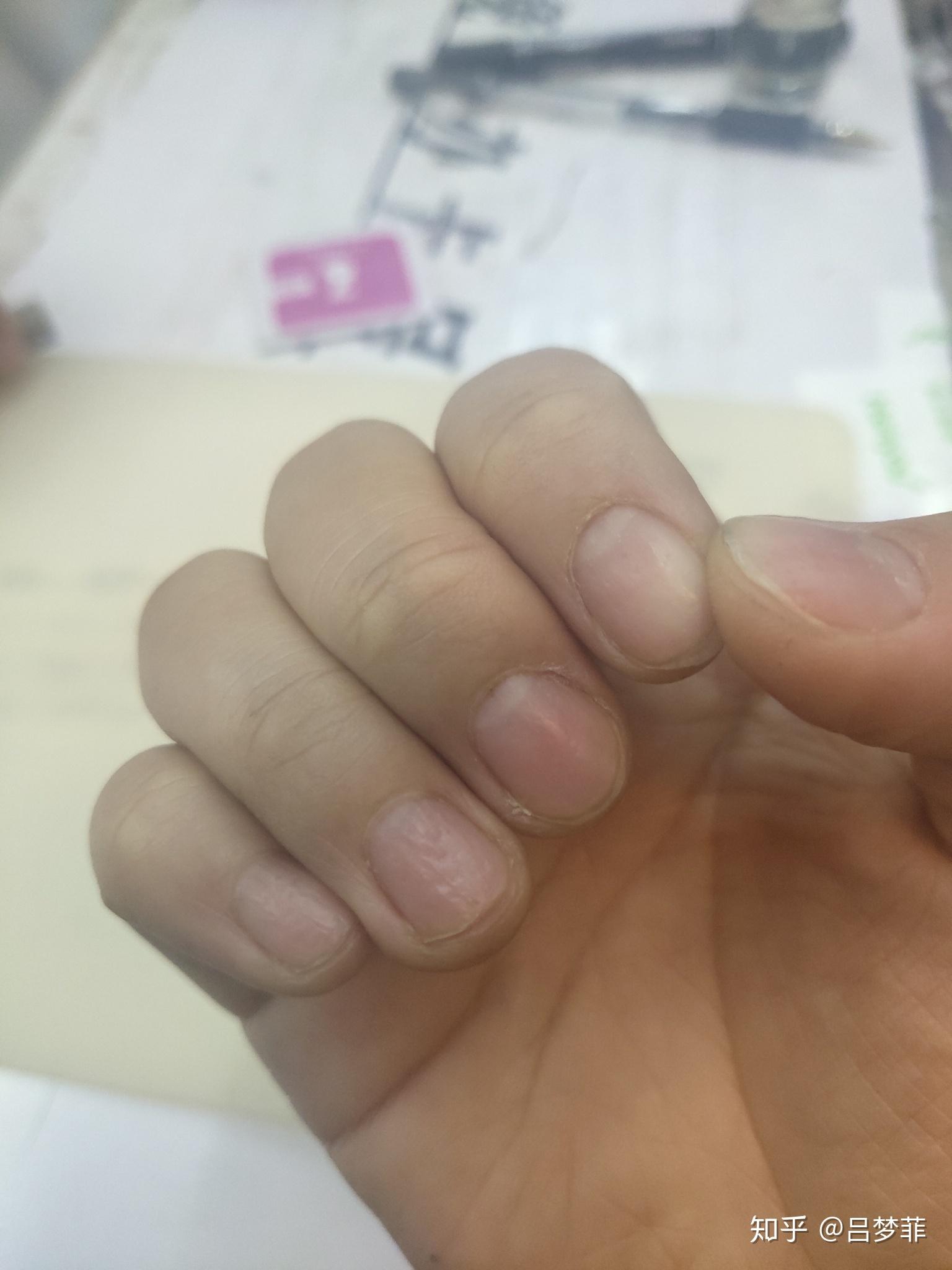 手指甲上全是小坑是怎么回事呢? - 知乎