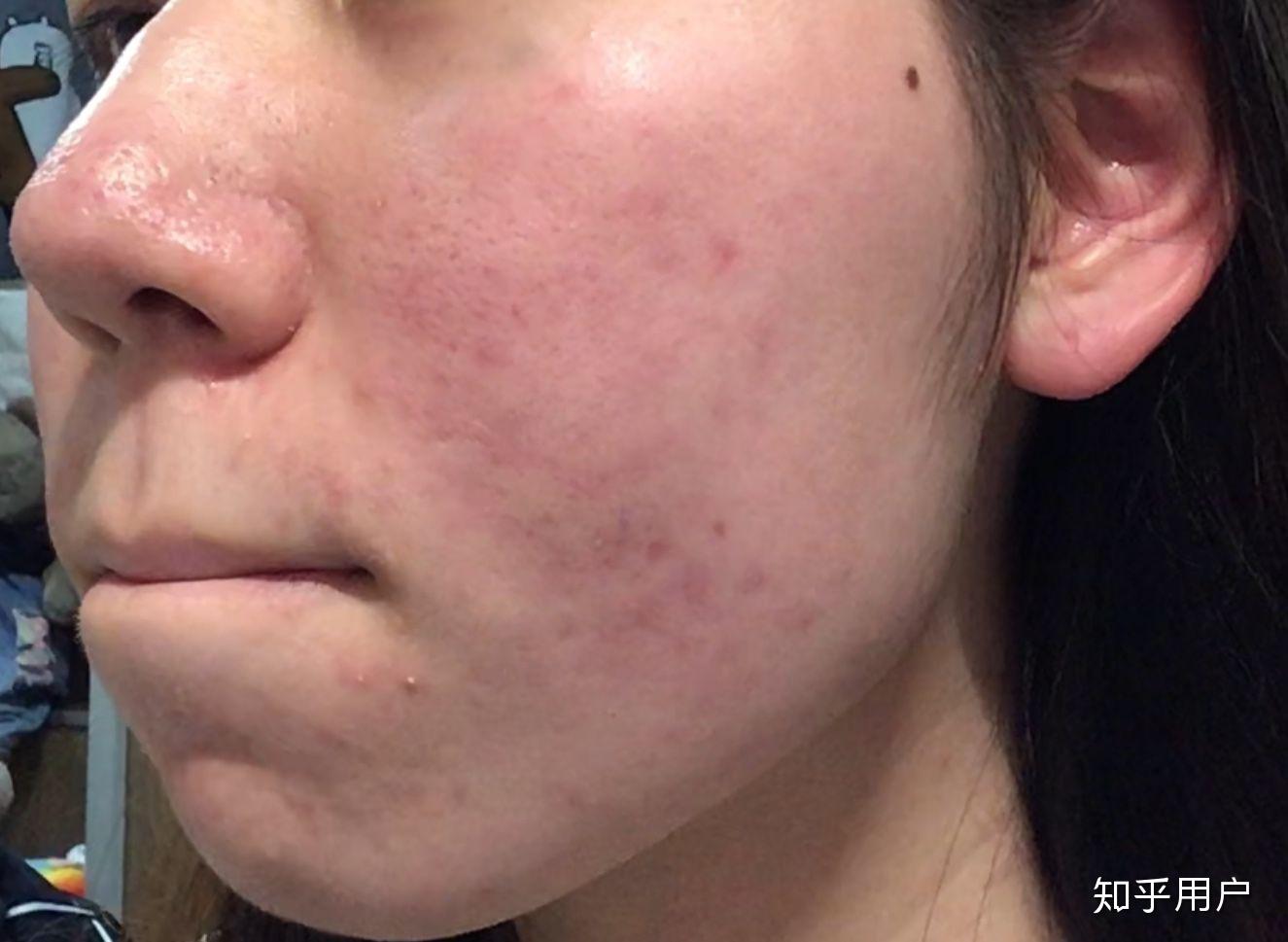 玫瑰痤疮怎么治? - 知乎