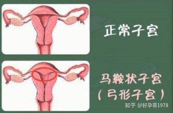 鞍状子宫会影响排卵和怀孕吗要如何调理