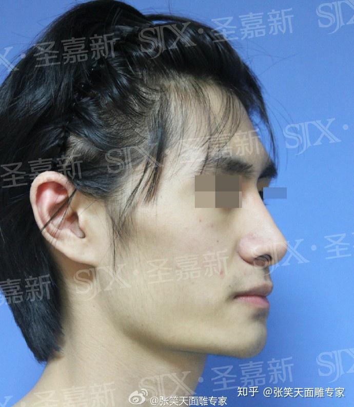 我一个男生想去削骨,可以吗?