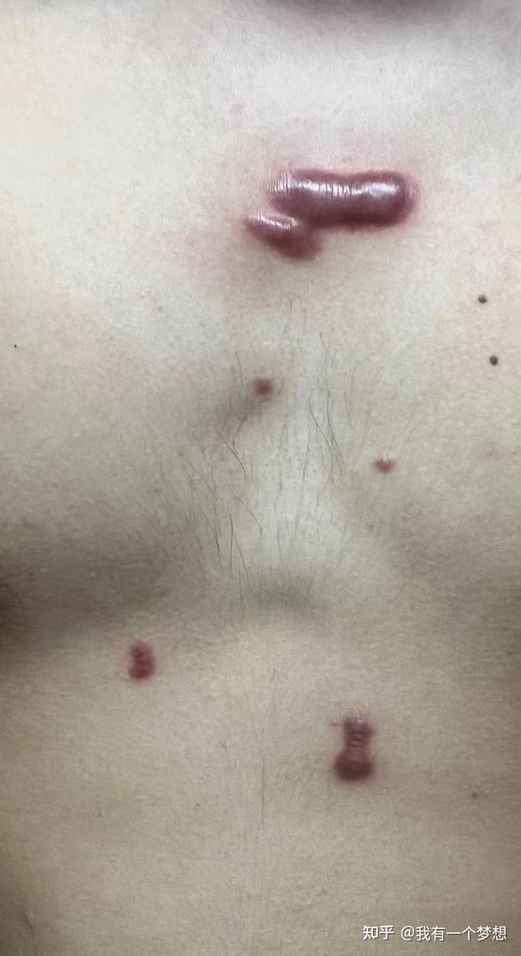 疤痕疙瘩怎么治?