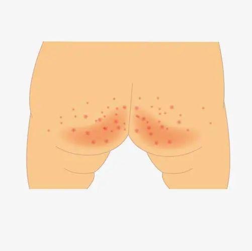 屁股经常性发痒越抓越痒怎么回事