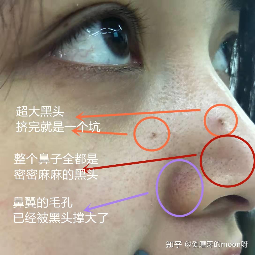 手贱挤黑头挤出一个洞怎么办? - 知乎