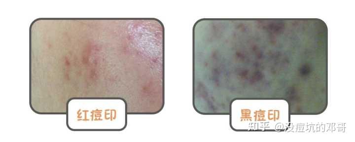 请问如何分辨红色痘印与黑色痘印? - 知乎