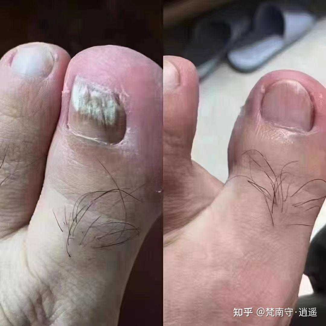 灰指甲为什么对称长? 