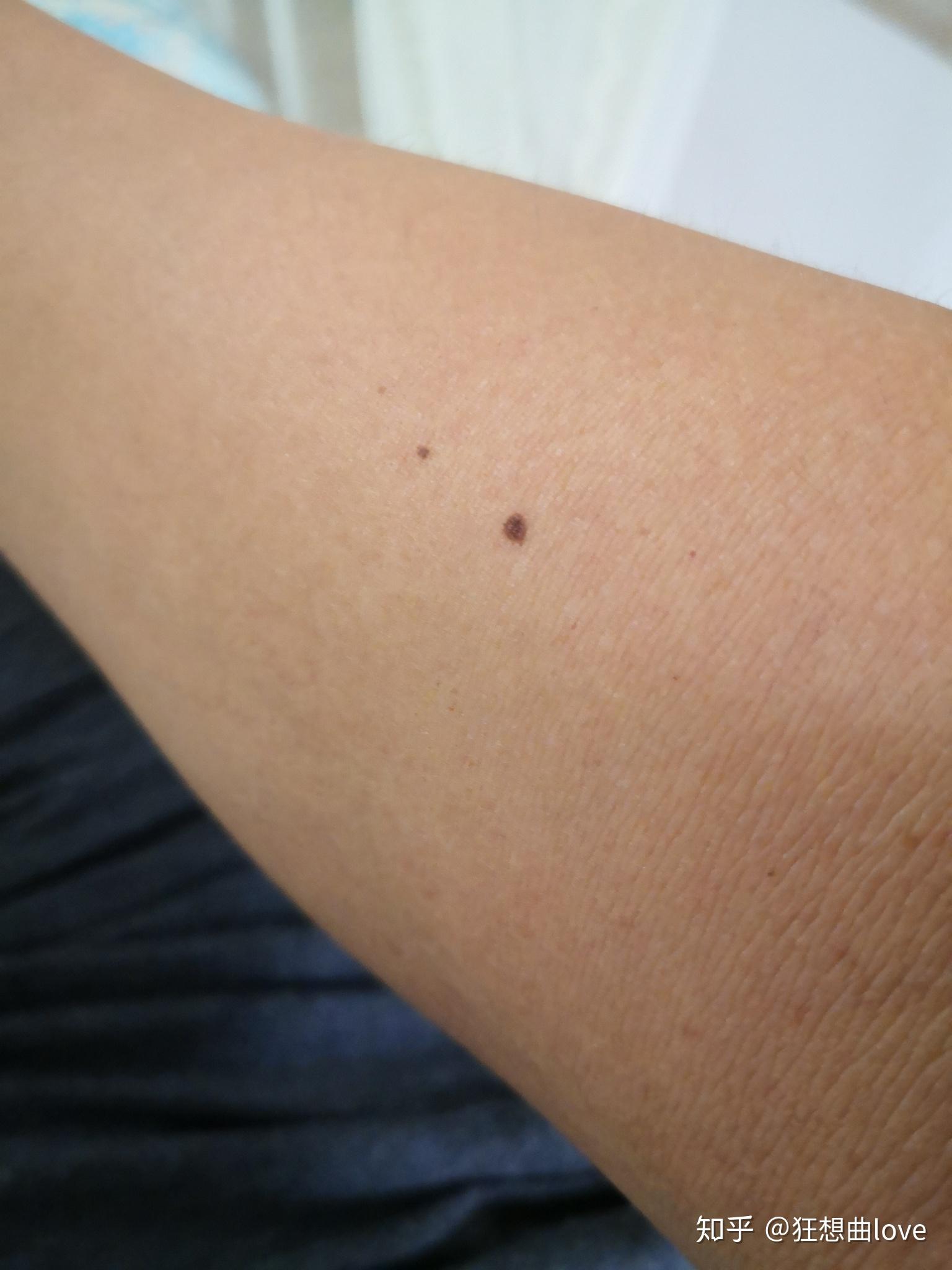 身上忽然长出很多小黑点.这是什么?