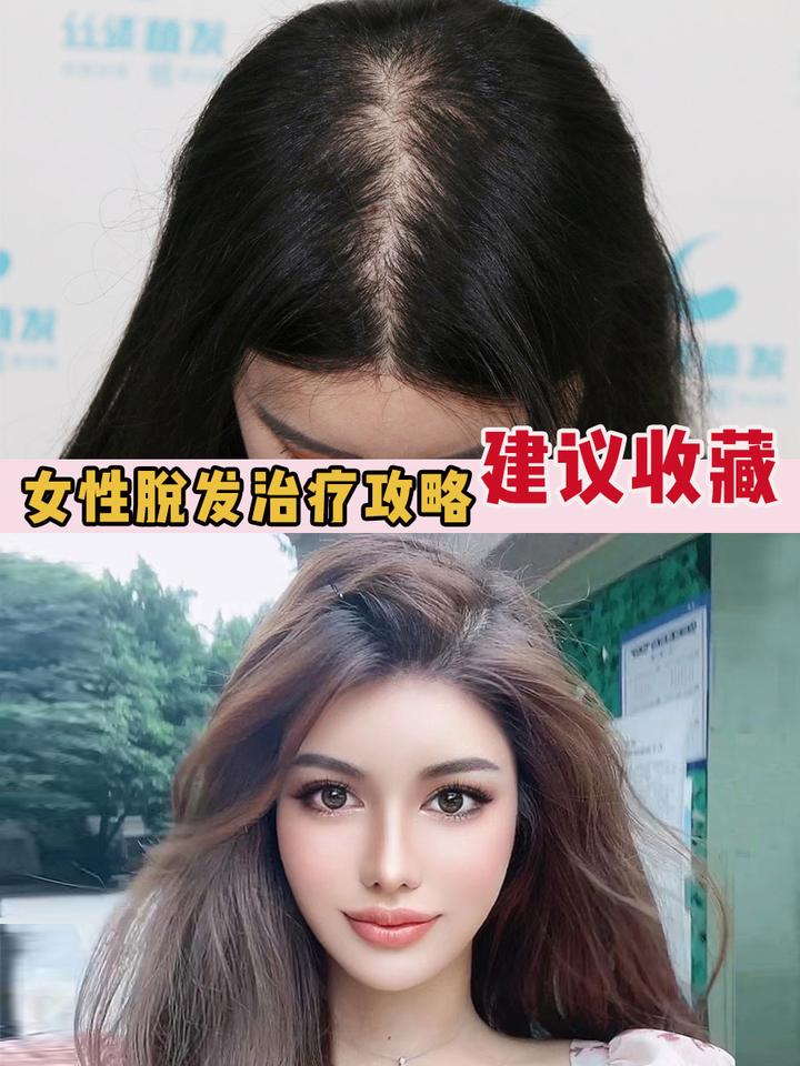 女性脱发、发缝宽、发际线后移，有效方案在此 - 知乎