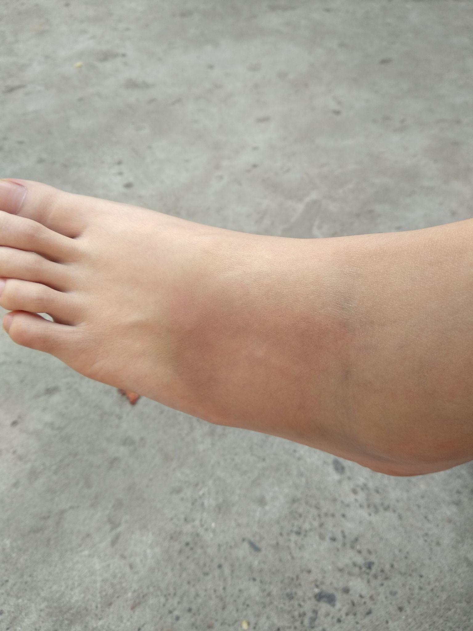 脚崴了怎么办? - 知乎