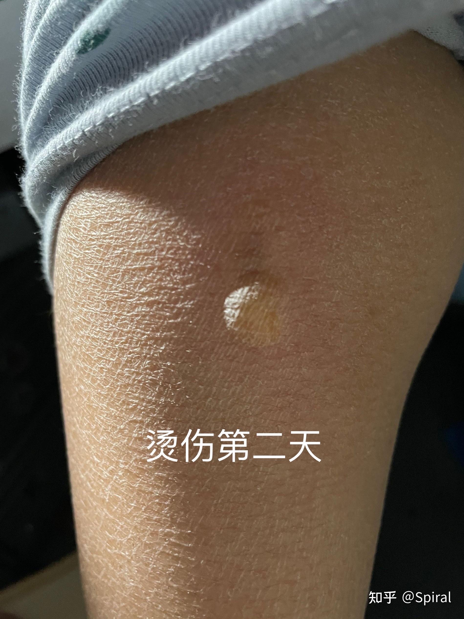 低温烫伤为什么难以愈合/恢复得很慢? - 知乎