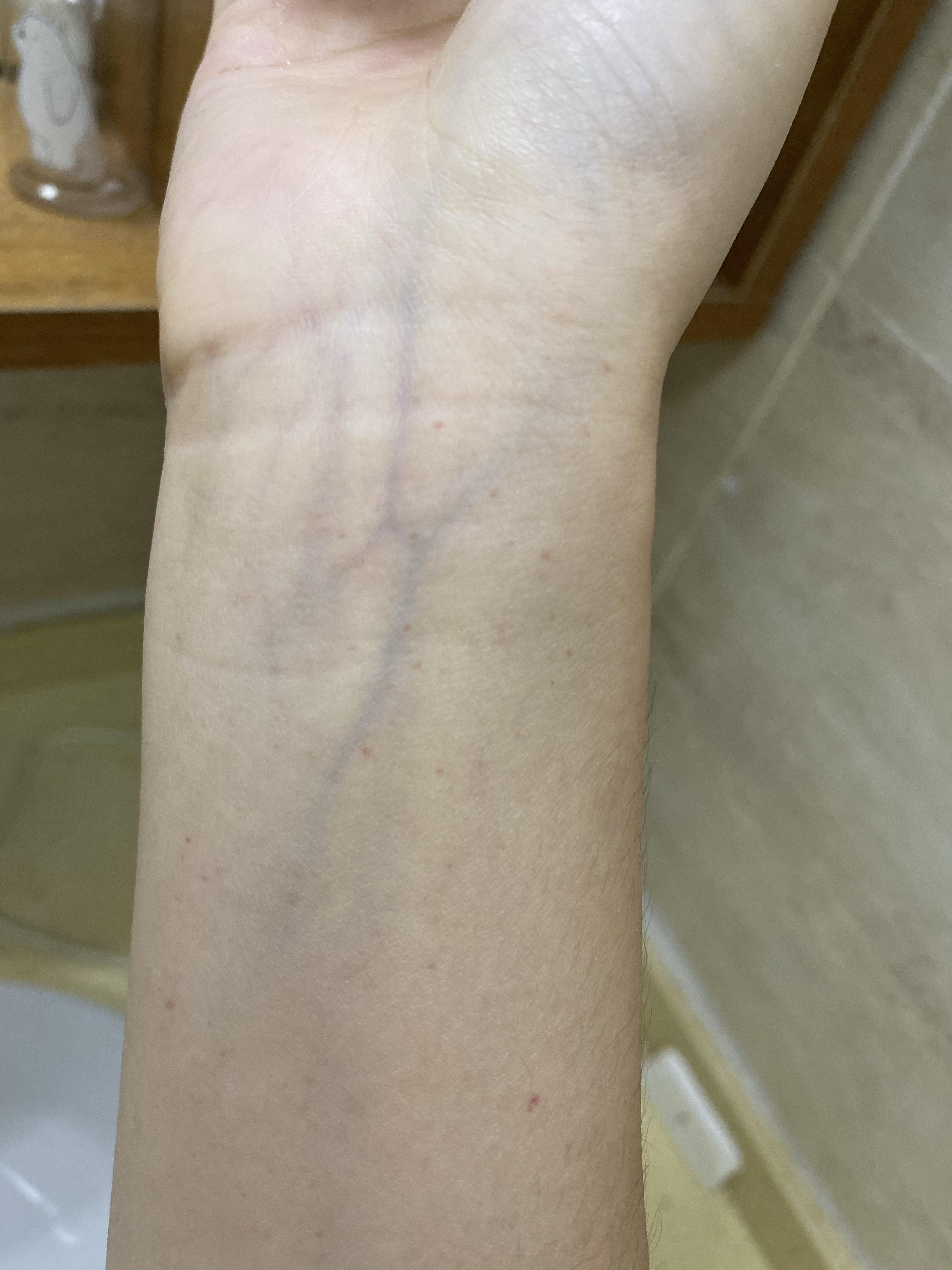 皮肤上面有一些小的血点,像是血不高于皮肤,很小,右胳膊上有很多仔细