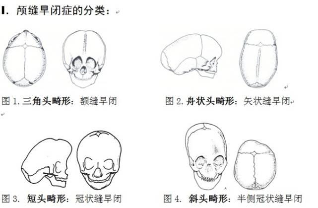 颅缝早闭症（3）--正常颅缝和囟门闭合的时间- 知乎