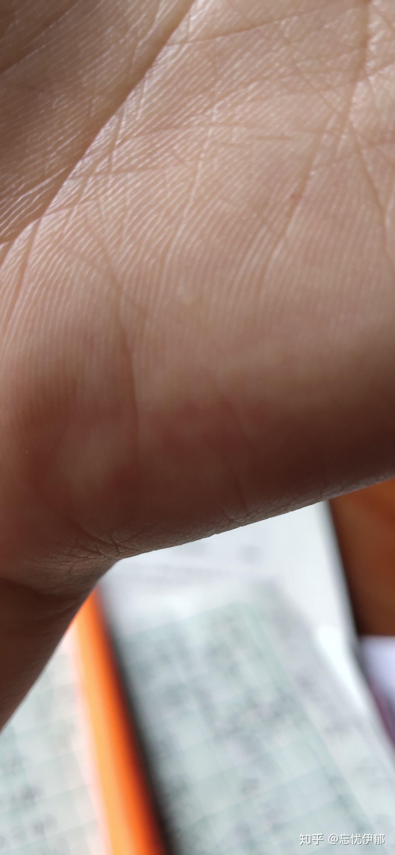 手部皮肤上长了透明小包(小疙瘩),不痛不痒,微硬,请问这是什么?