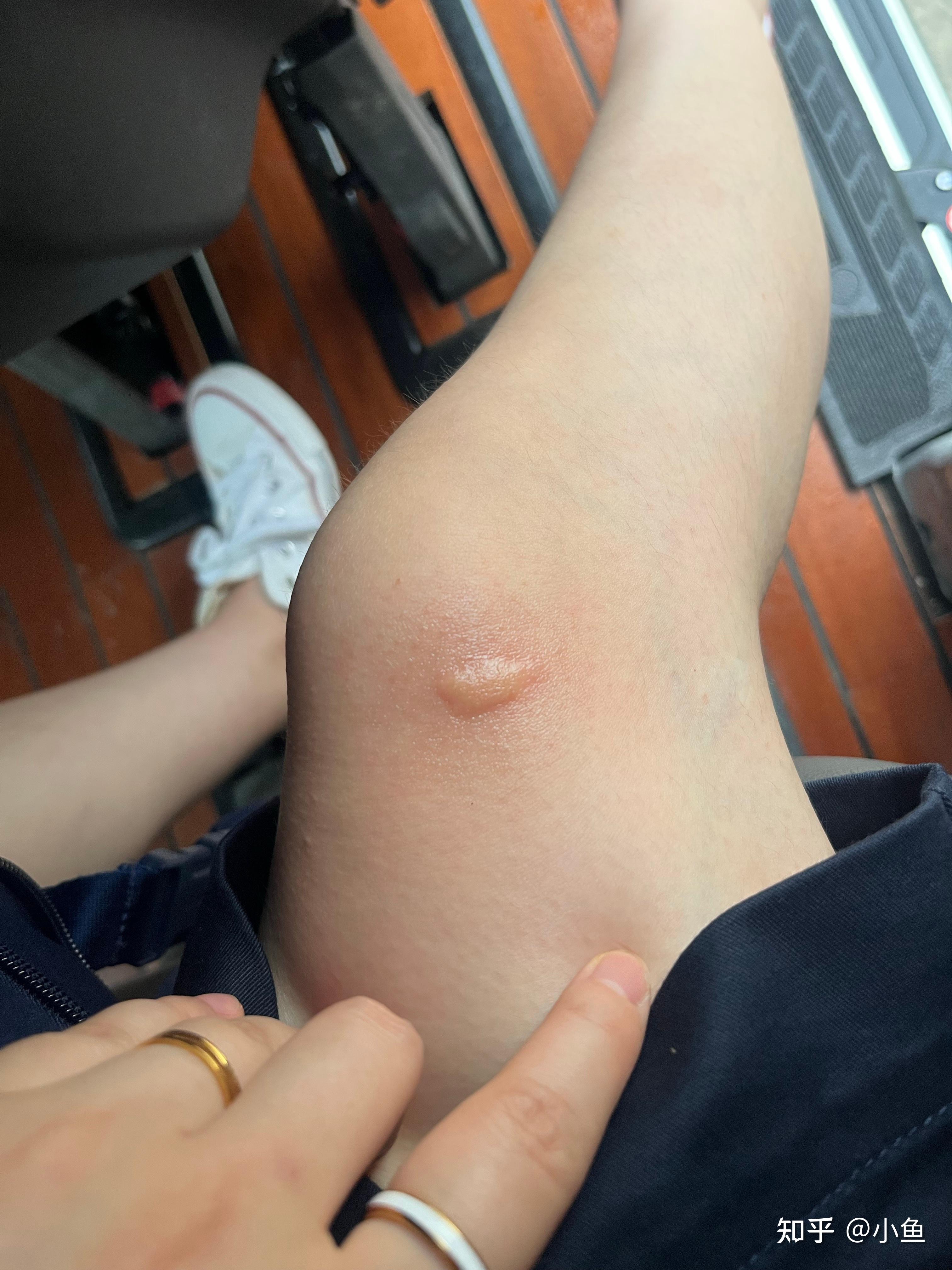 被蚊子咬的包第二天都肿的特别大怎办?