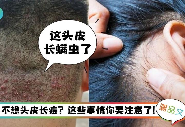 《科普》头皮长痘痘也属于皮肤问题?5大原因你可能忽视了! - 知乎