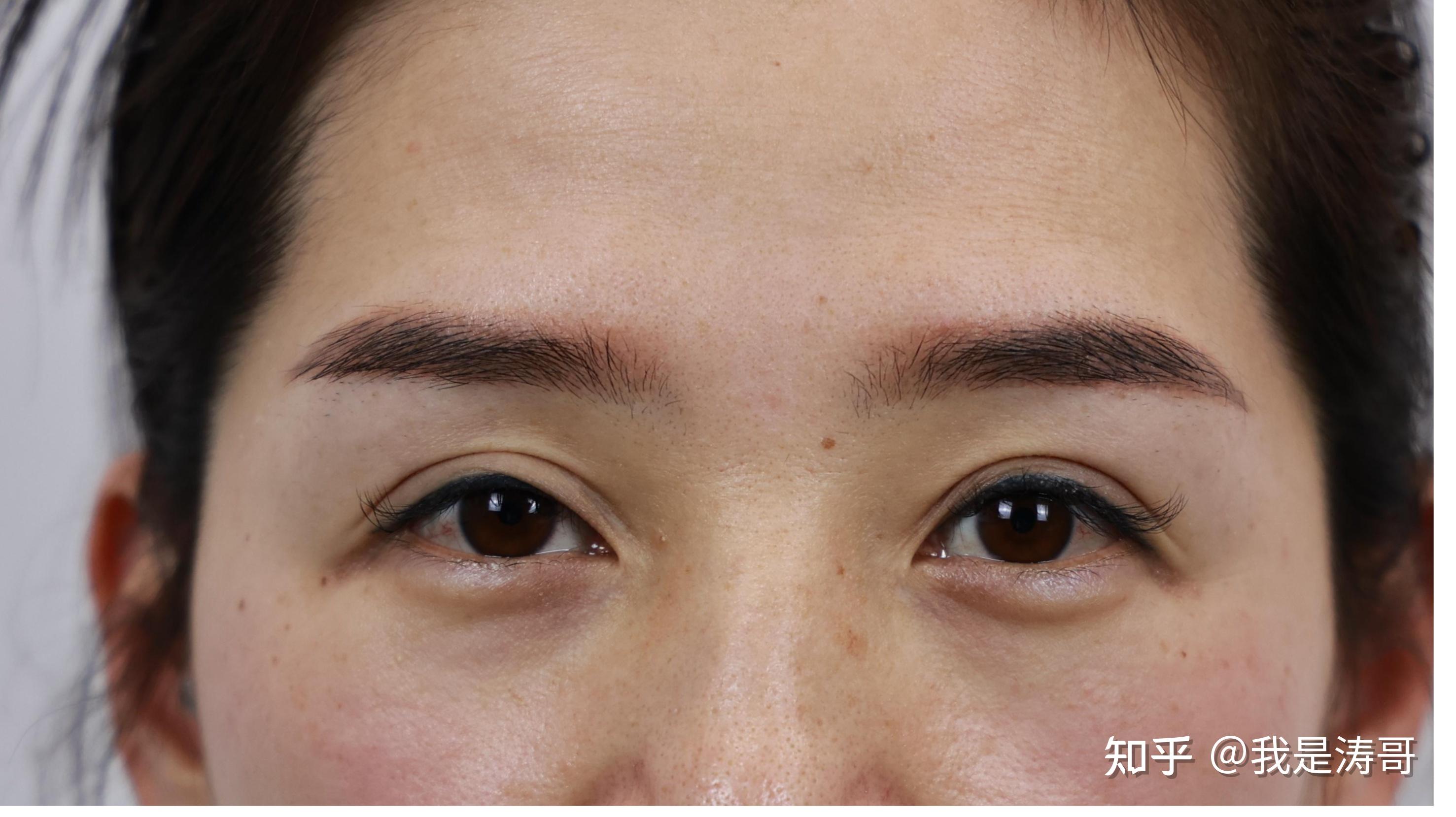 双眼皮割太长了,显老怎么办?