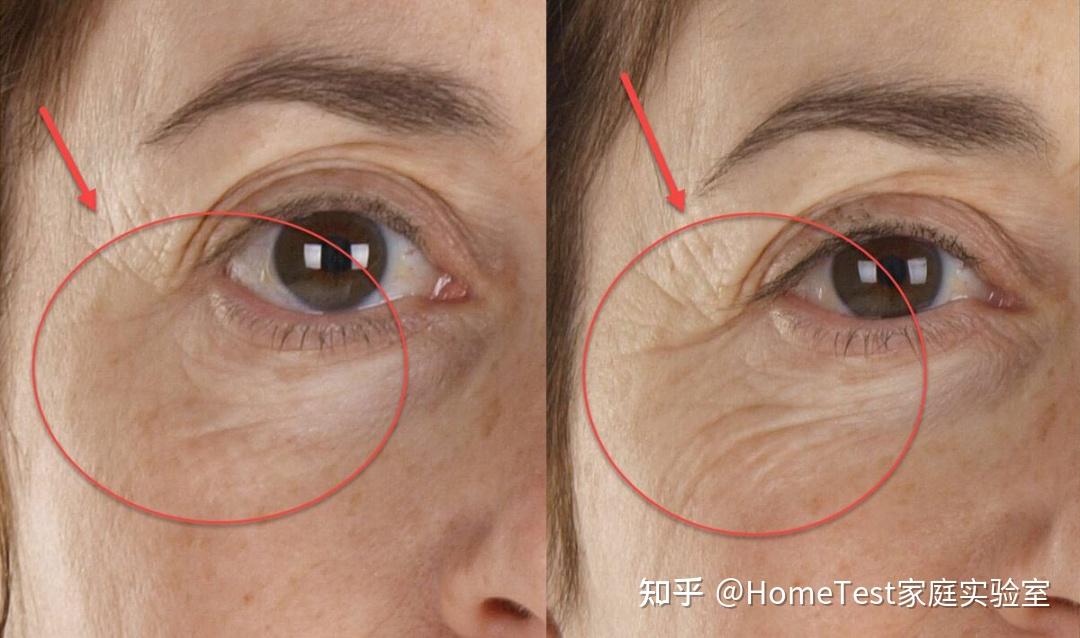怎么有效快速地去特别严重的眼纹?用眼霜可以消除小细纹吗? - 知乎