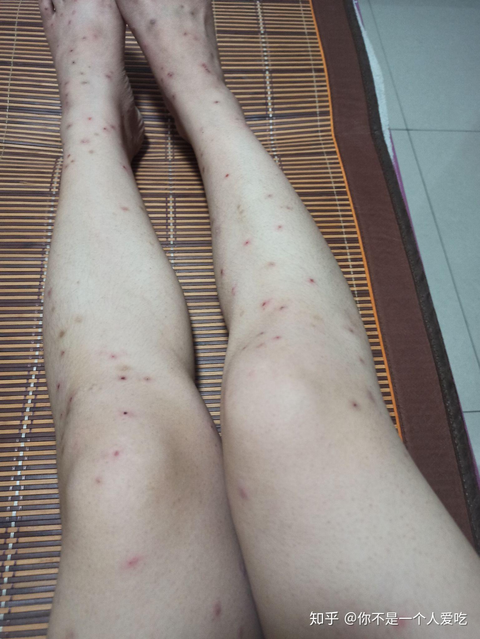 被飞蠓咬了很长时间没好去了医院也没有很好的效果有没有好的解决方法