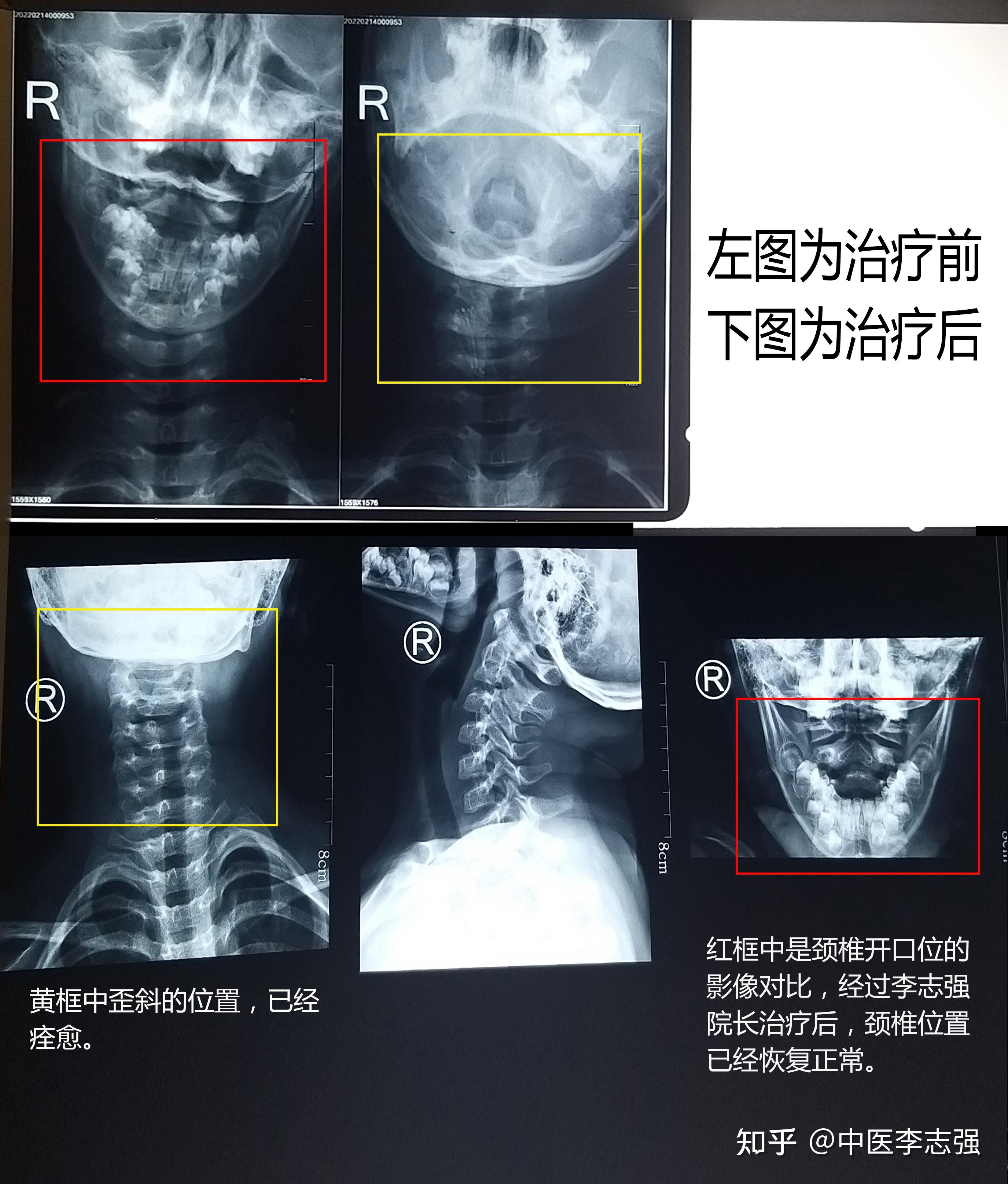 先天性斜颈的症状图片