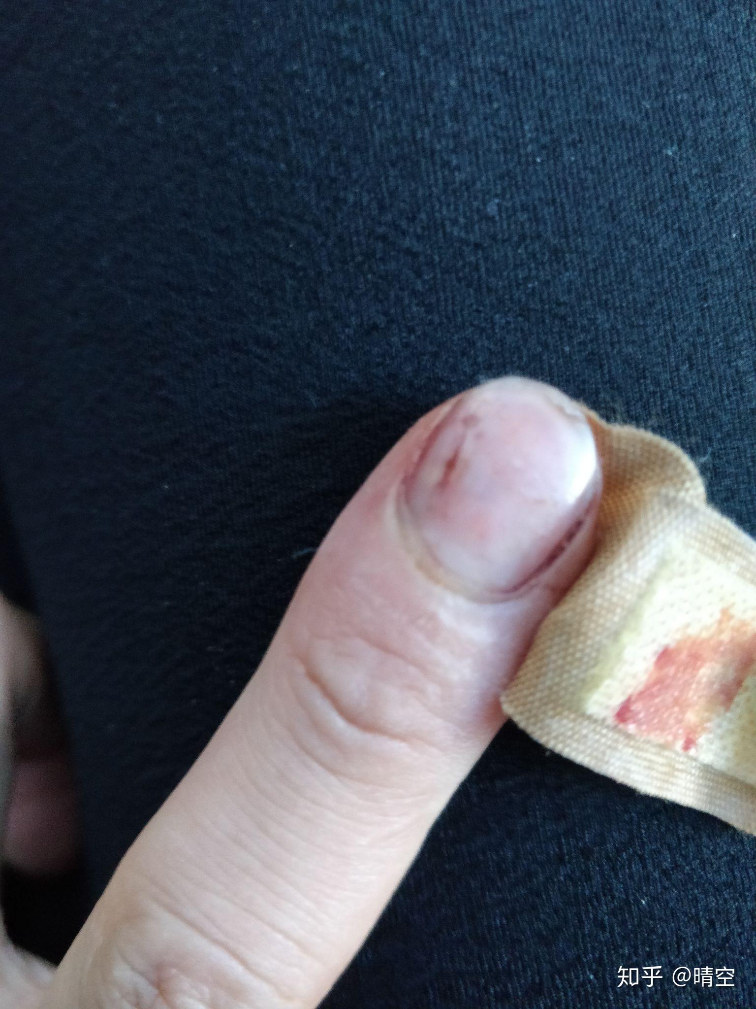 手指被夹指甲淤血图片