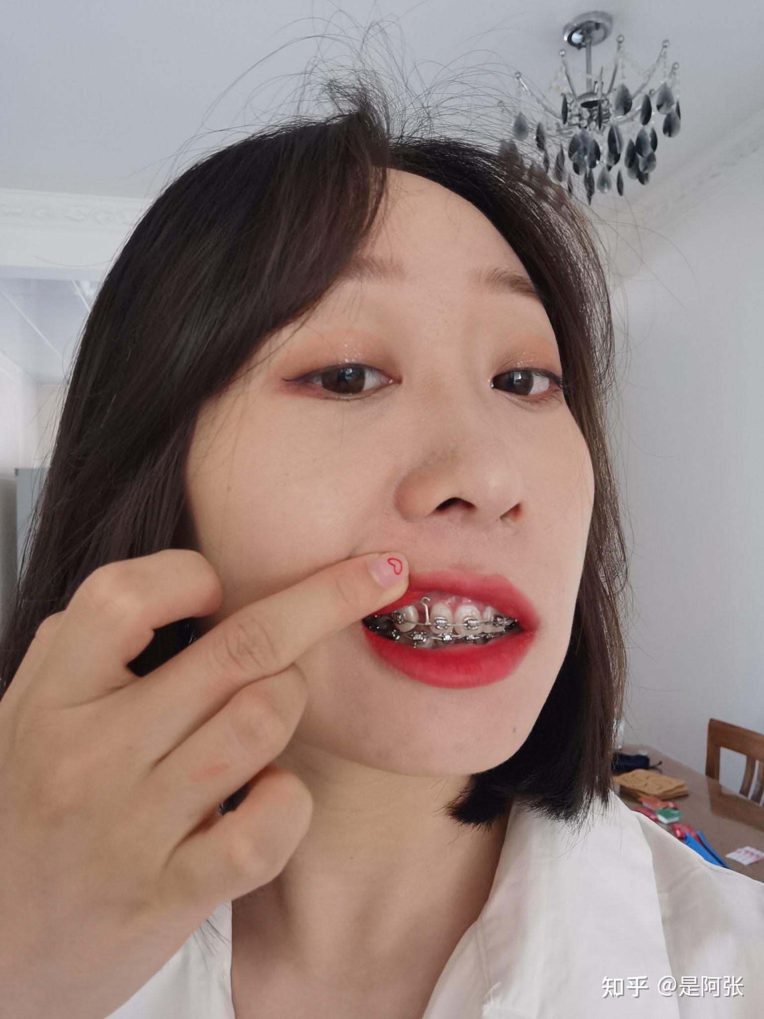 戴过牙套(矫正牙齿)的人脸型变了吗? - 知乎