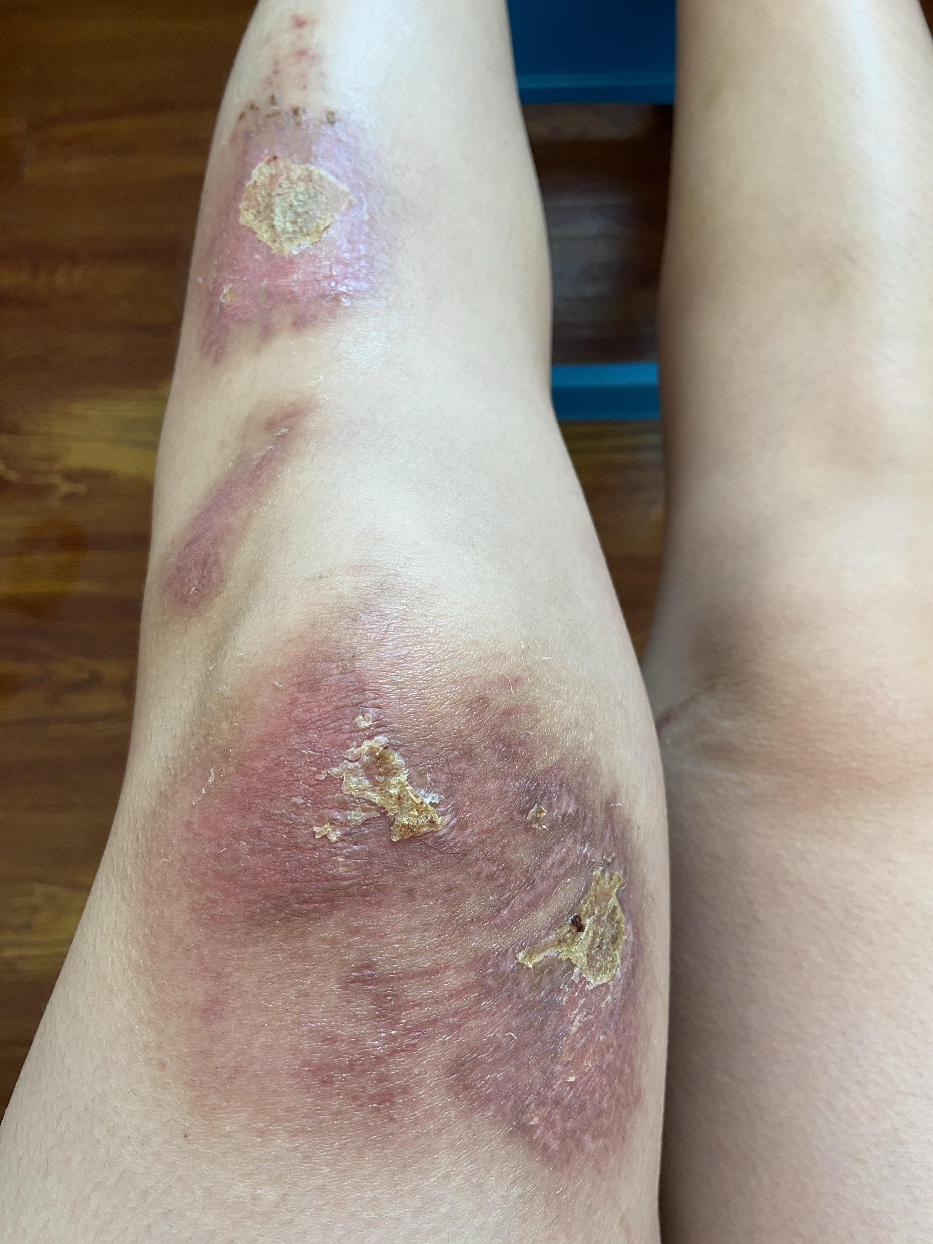 膝盖摔伤抹了碘伏结痂后如何防止留疤