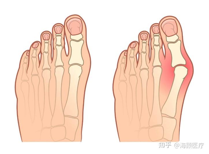 鞋子真的是祸首吗？关于拇囊炎的五大误区 - 知乎