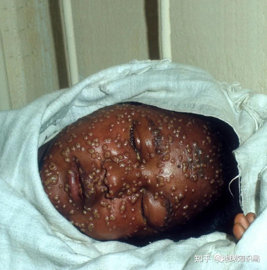 「天花」是一种怎样的传染病? - 知乎