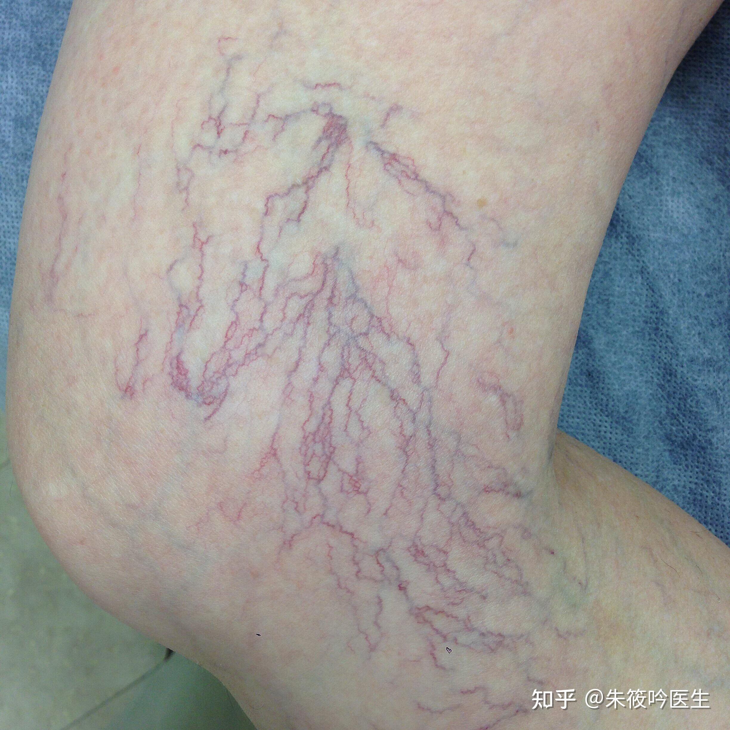 女生腿上有网状红血丝是怎么回事,该怎么改善? 