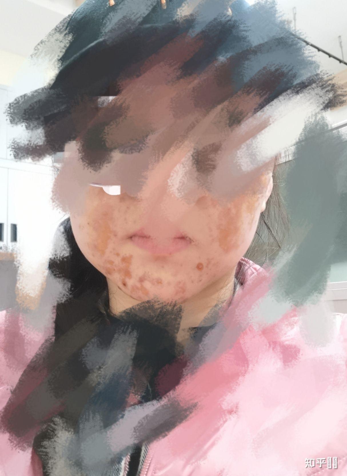 果酸灼伤是什么体验?