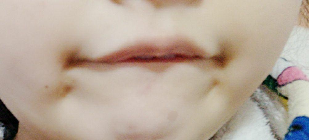 嘴角下有个窝不是梨涡是什么