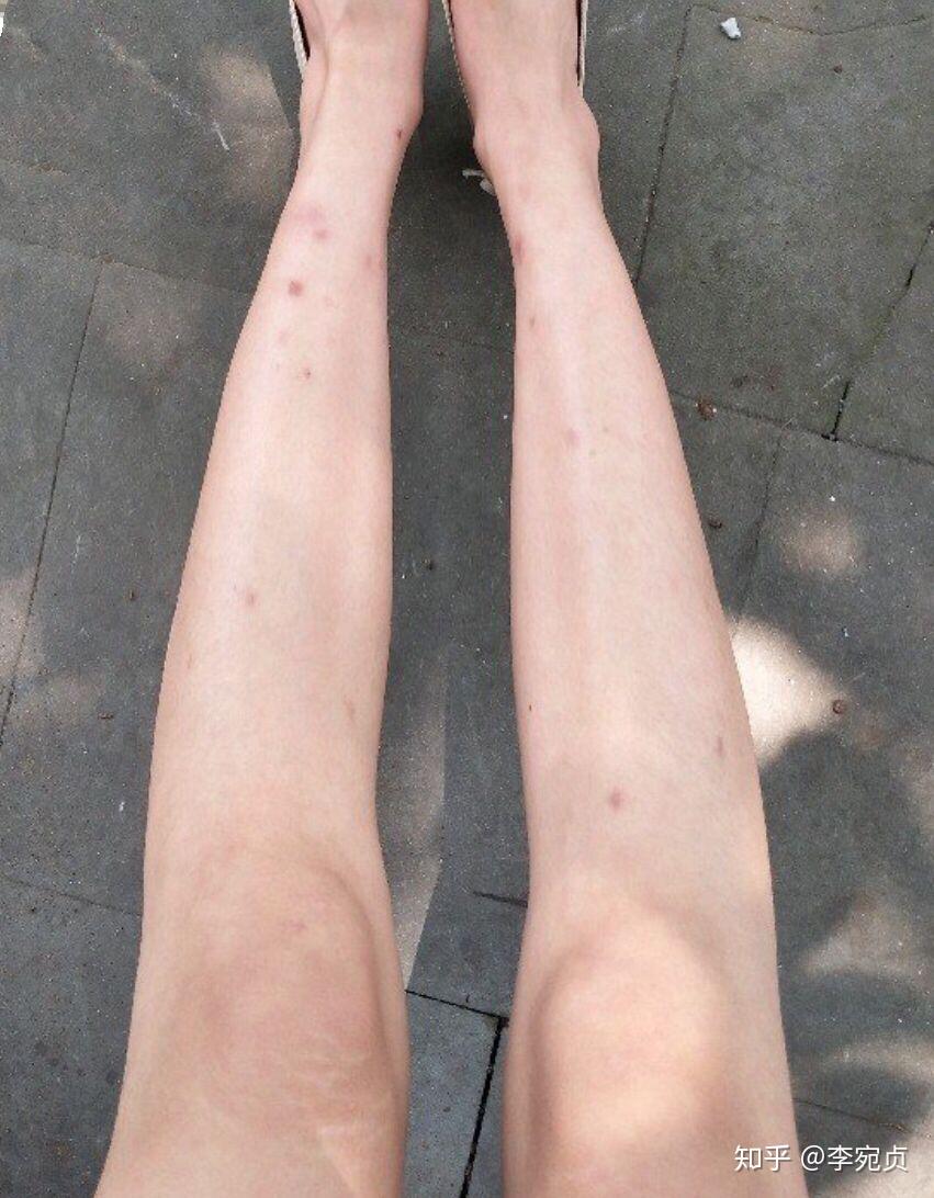 每到夏天,手上腿上被蚊子咬后,疤痕许久不消,怎么办? 