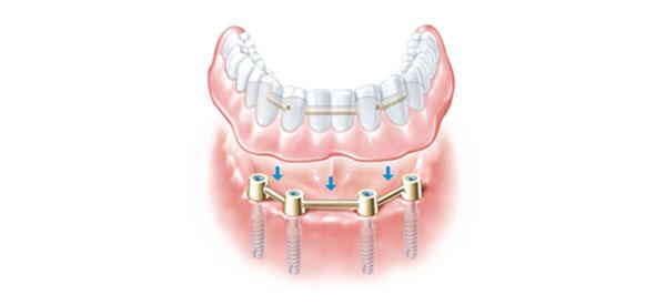半固定种植牙的分类!