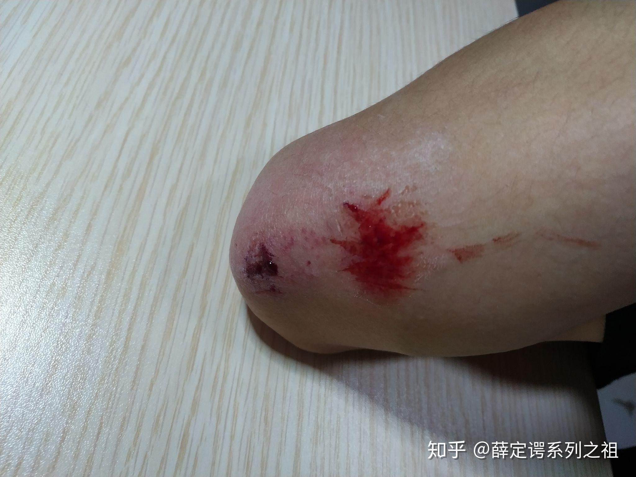 你们学滑板和轮滑时用了多长时间你摔了多少次惨吗