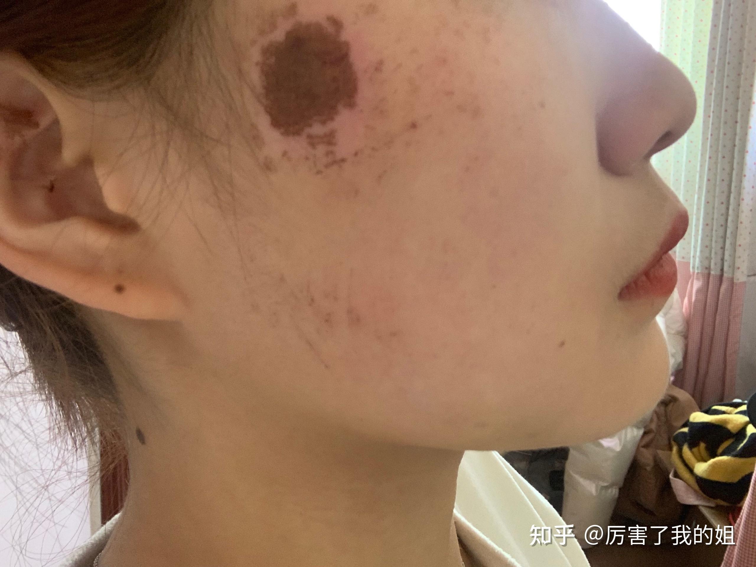 脸上擦伤结痂记录希望大家能给出专业建议不让留印