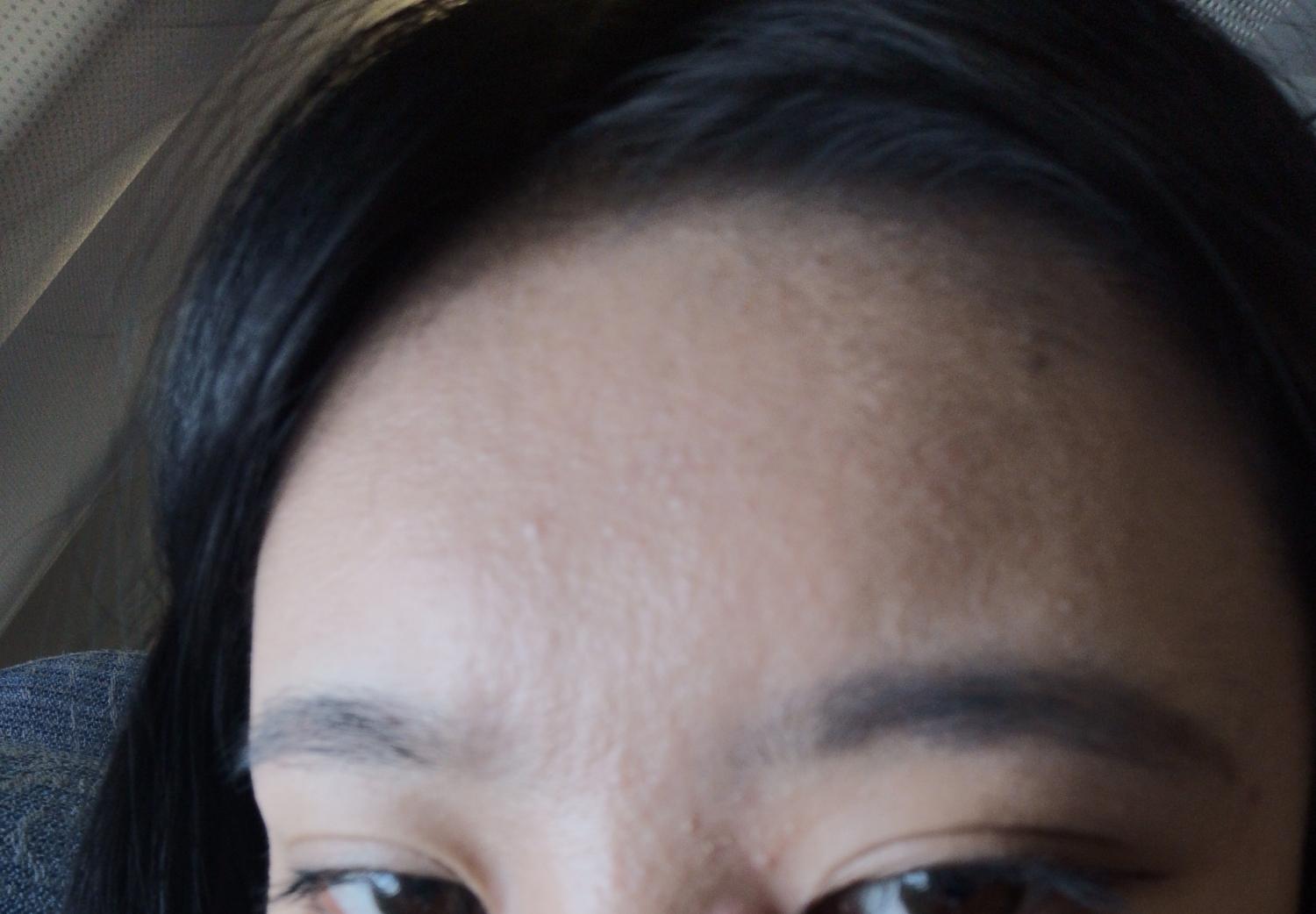 额头长了好多小疙瘩,这是粉刺还是痘痘还是脂溢性皮炎? - 知乎