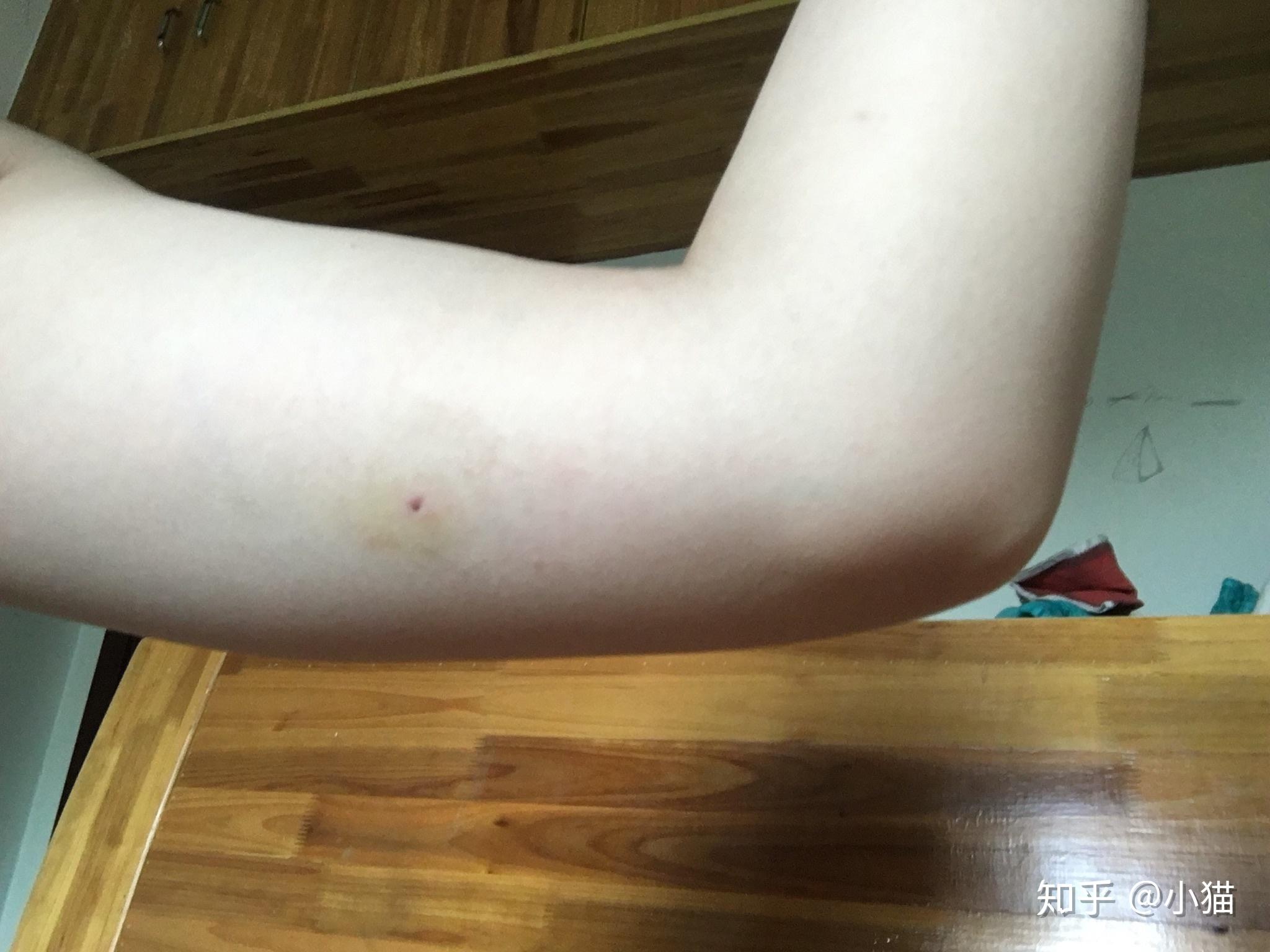 有小伙伴试过皮下埋植避孕法(implant)吗?是怎么样的体验?