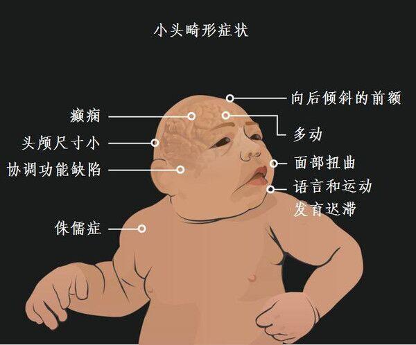 满月宝宝小头畸形图片图片