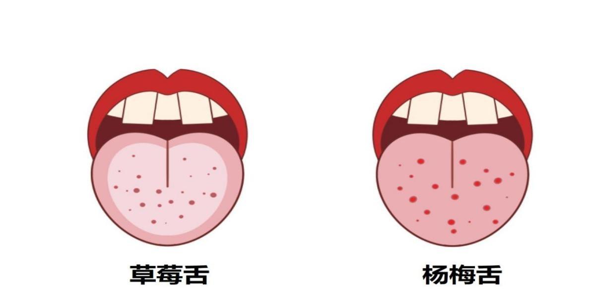 怎么办?宝宝突然发热、咽痛、起红疹,还有草莓舌…… - 知乎