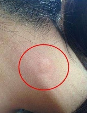 女子高烧,咳嗽,一直以为肺炎,医生看到脖子上的伤口后:艾滋病
