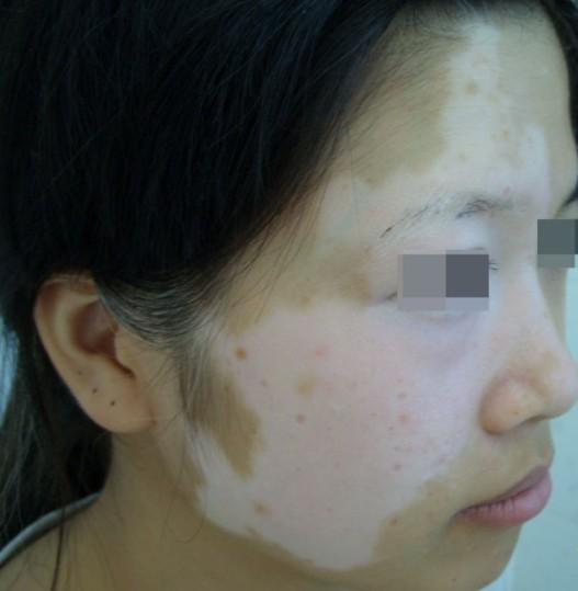 女性脸部白癜风该怎么护理? - 知乎