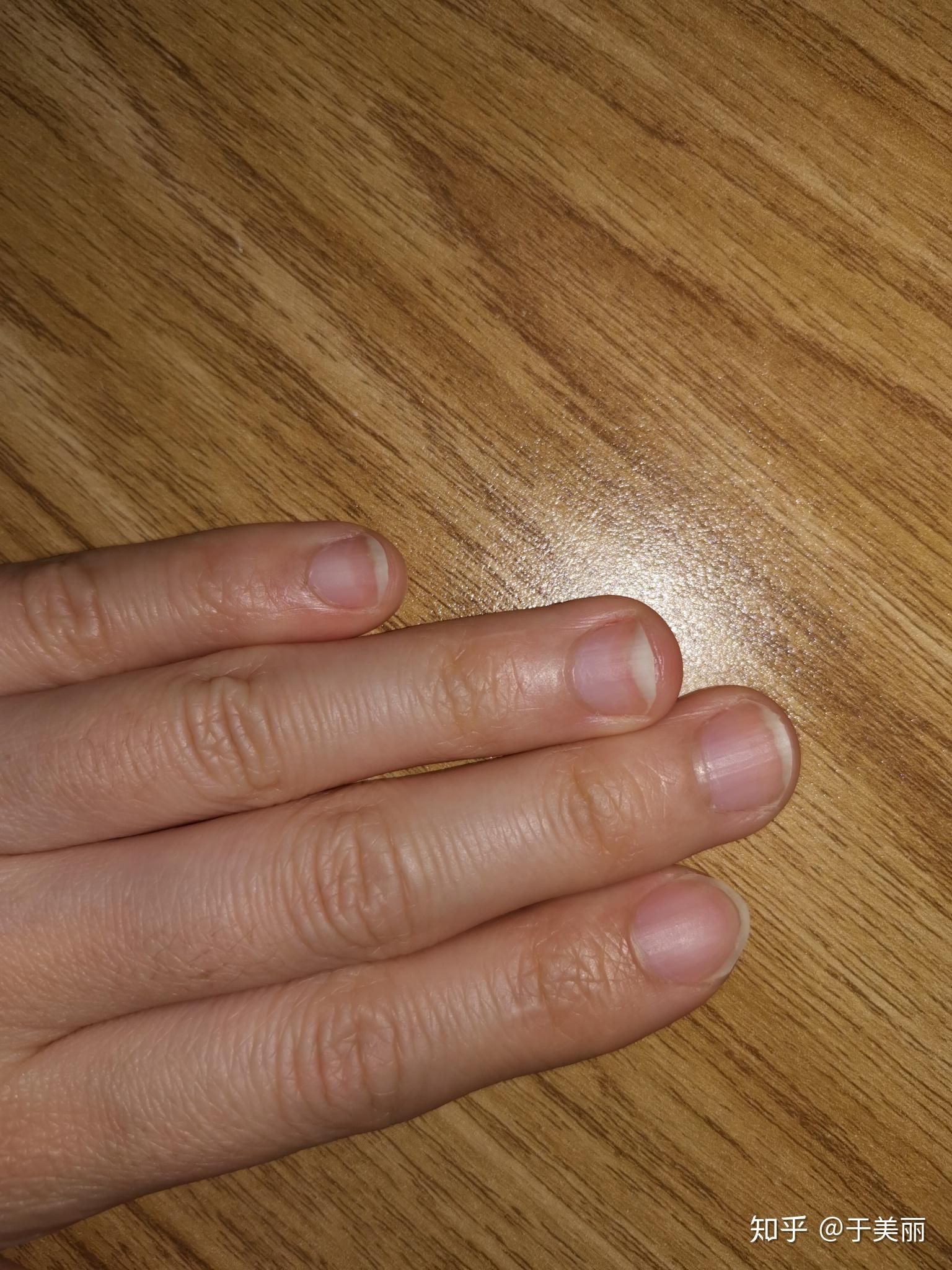 我的指甲上翘特别严重……发白……什么原因?如何改善?