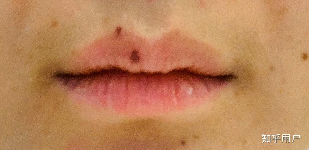 嘴唇上最近长了几个黑点像痣又像斑怎么能去除