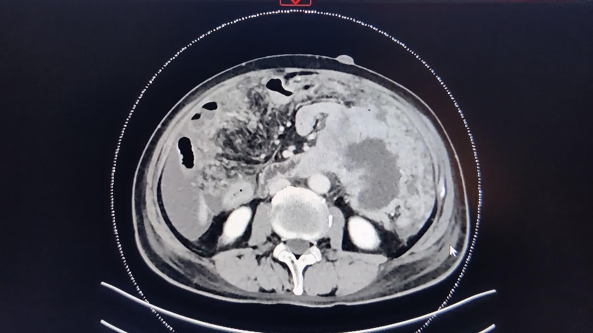 晚期腹腔间质瘤(胃肠间质瘤),减瘤成功解除梗阻,附ct图像,难度不低!