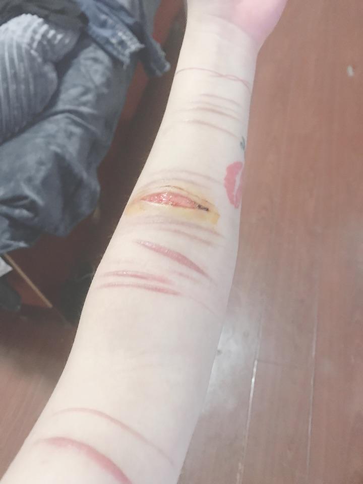 自残的你是怎样处理伤口的? - 知乎