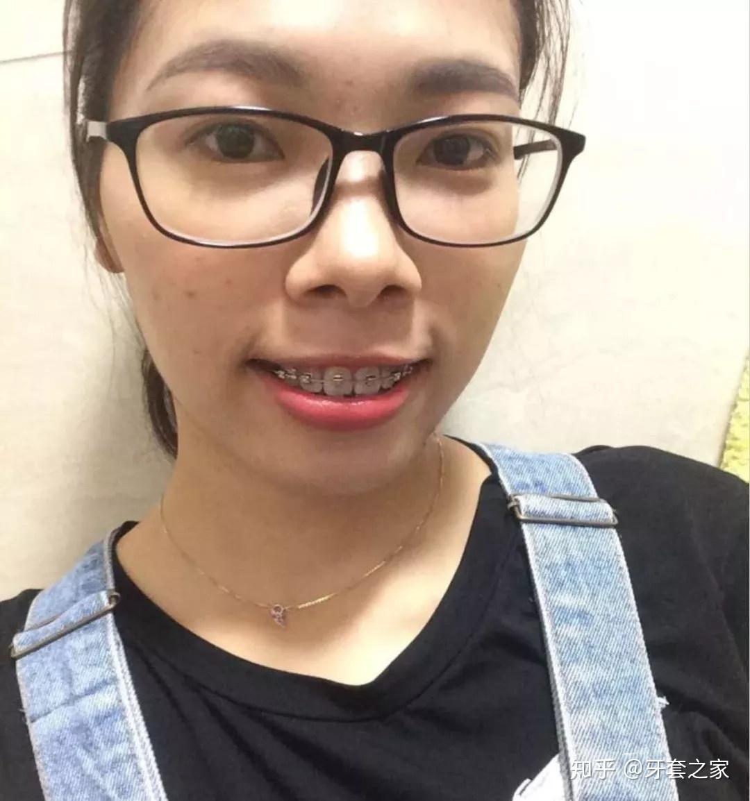 因为龅牙不自信是怎样的体验? - 知乎