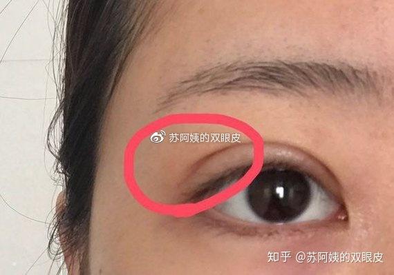 割双眼皮后出现褶皱