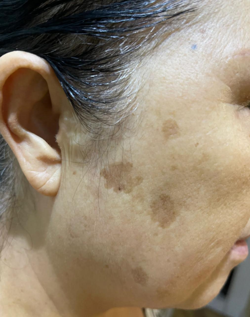 【医学美容】10种常见良性体表肿物，看看你的是什么？ - 知乎
